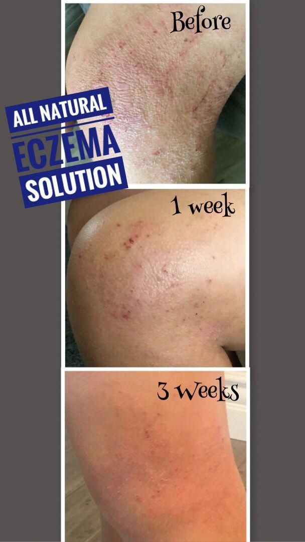 Healing Honey Eczema Cream