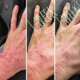 Healing Honey Eczema Cream